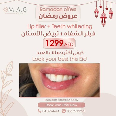 Ramadan Offer Lip Filler plus Teeth Whitening 1299 AED