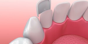 Evaluation of the success of Veneer