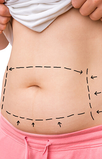 Tummy Tuck