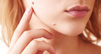 Moles Removal