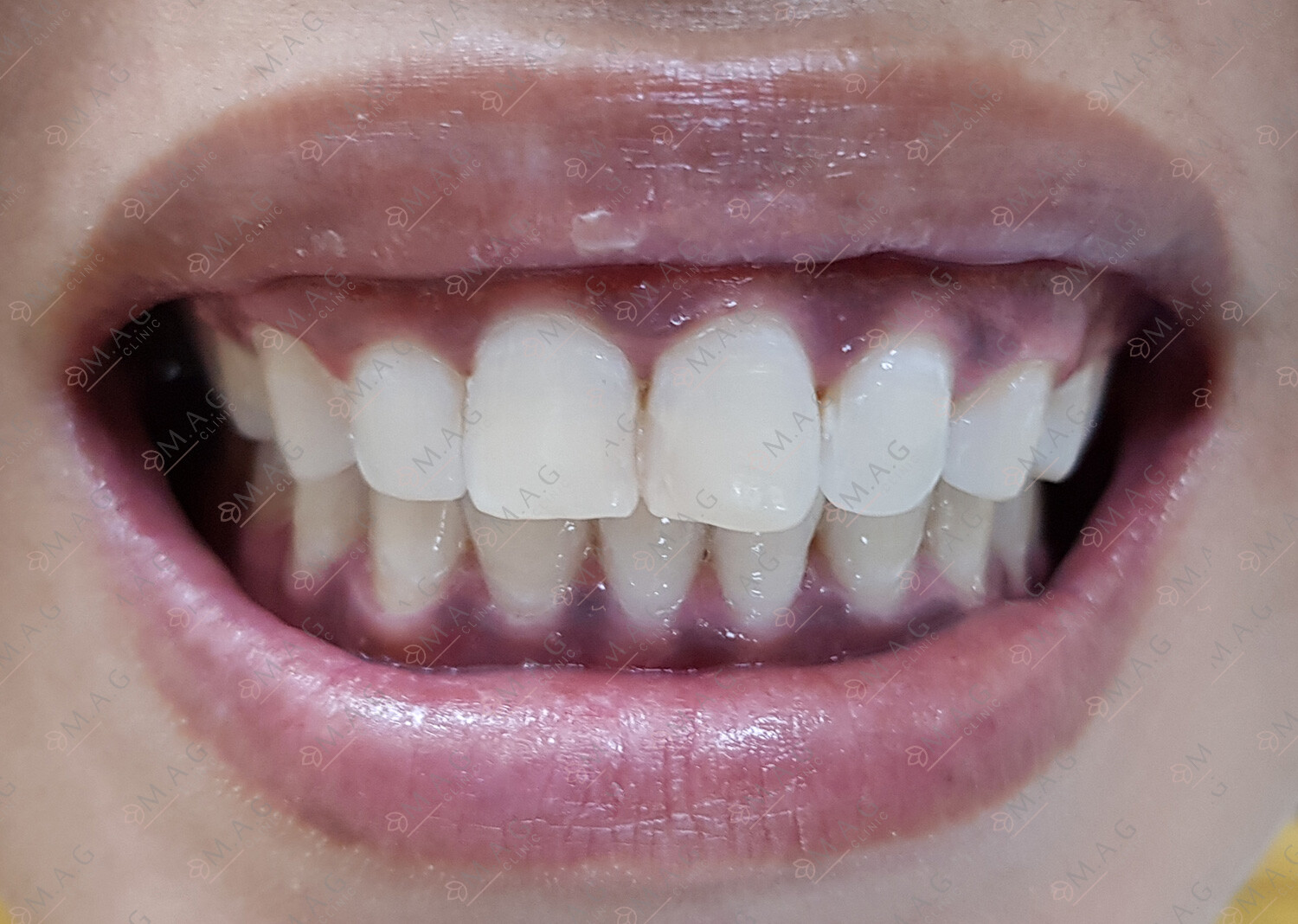 Teeth Whitening Dubai MAG Clinic