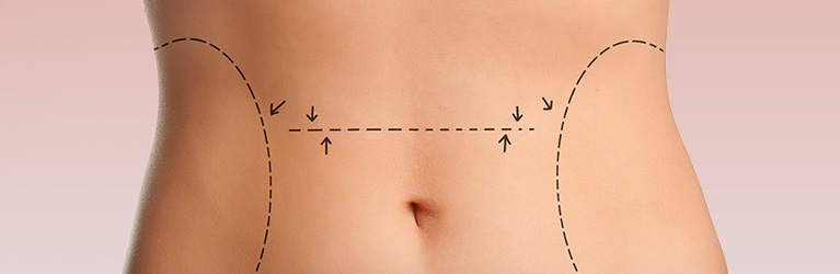 Liposuction